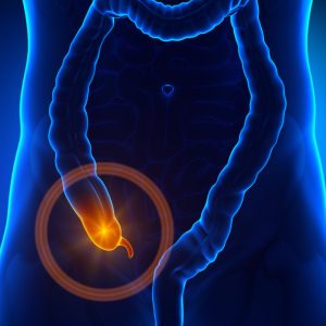 A Quick Guide to Appendix Surgery