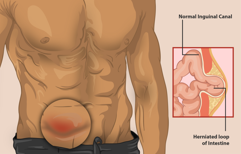 Hernia Repair: Types, Symptoms, and Treatment Options - Best